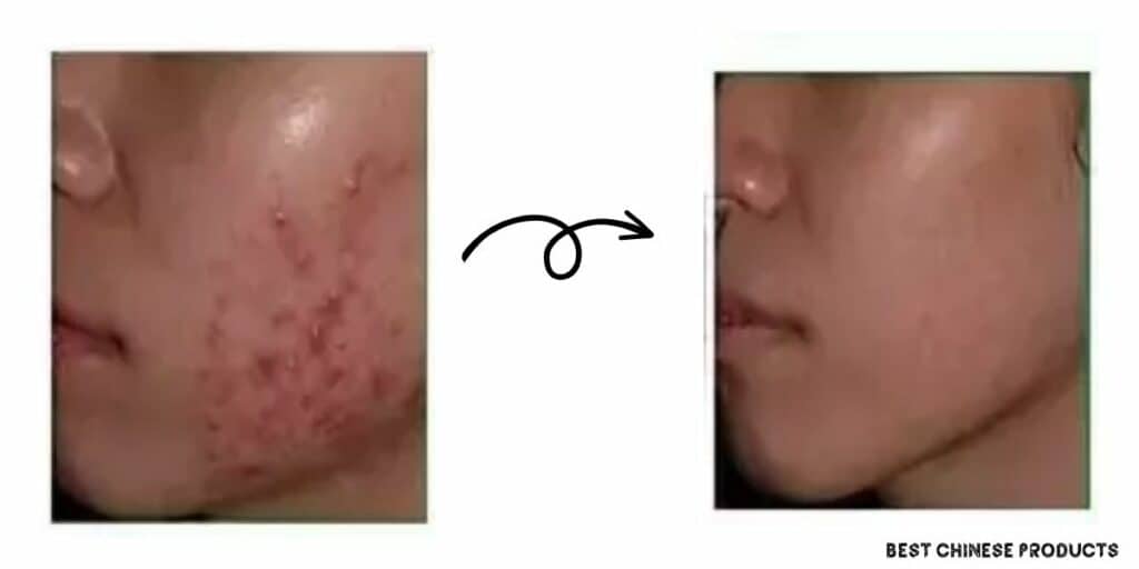Can Bioaqua products help in scar removal?